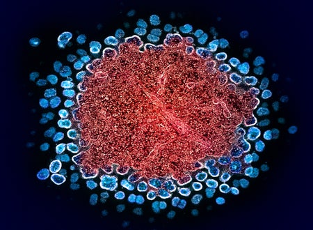 Colorized transmission electron micrograph of numerous HIV-1 virus particles (blue) replicating from a segment of a chronically infected H9 T cell (red).