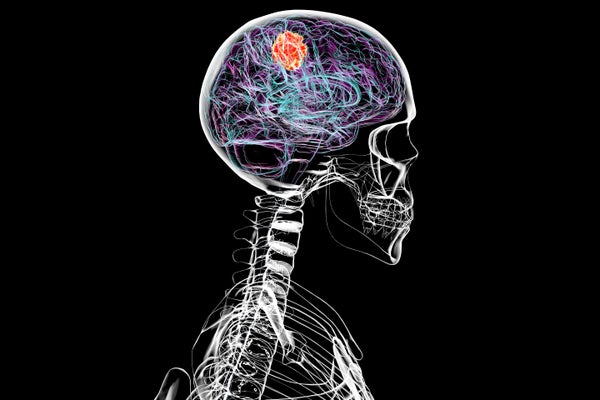 Computer illustration of a brain tumour