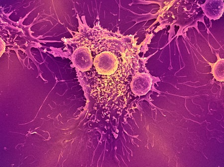 Pink scanning electron micrograph (SEM) of T lymphocyte cells (smaller round cells) attached to a cancer cell.