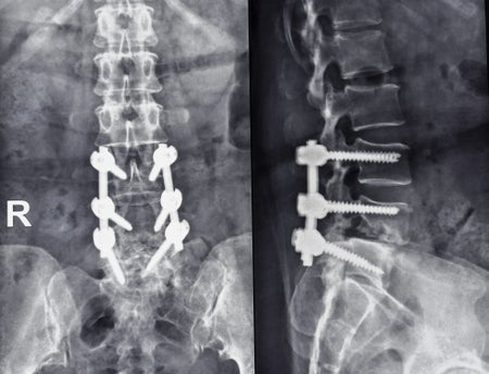 X-ray of the human Lumbar side by side with screws.